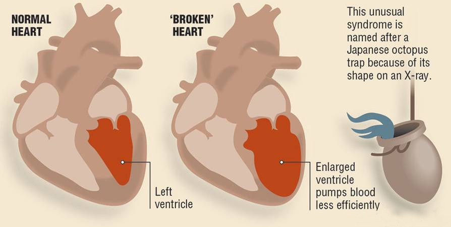Törött szív szindróma tünetei, típusai, okai, szövődményei
